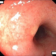 重度の低アルブミン血症による腹水がみられた症例の十二指腸